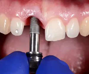 Implantes-Dentales-300x251