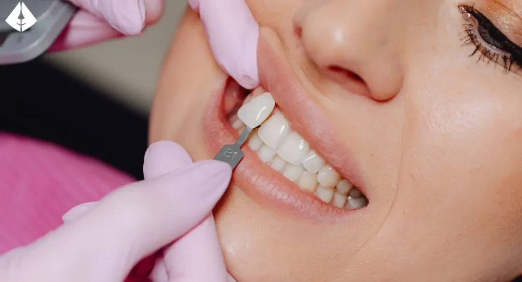 ¿Cómo Pueden Ayudar las Carillas Dentales con la Sensibilidad?
