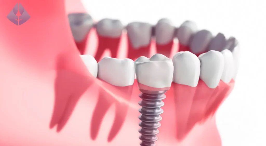 Beneficios de los Implantes Dentales Más Allá de la Solución Inmediata
