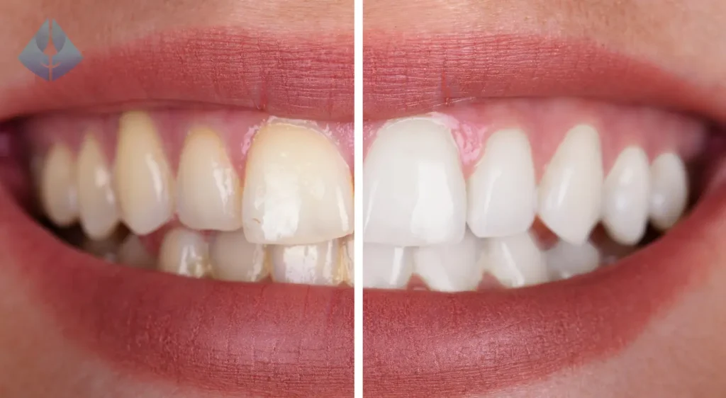 El impacto de una sonrisa desalineada en tu carrera