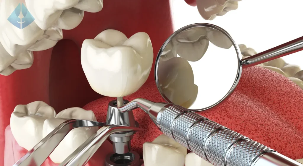 La Perspectiva de los Implantes vs. Prótesis Removibles