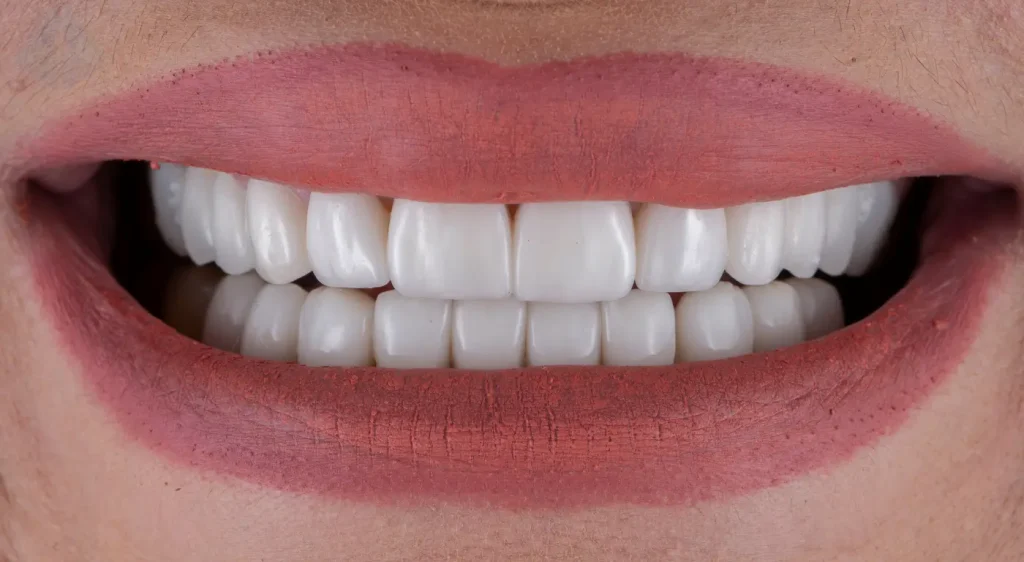 Primer plano del resultado natural de unas carillas de porcelana, mostrando una sonrisa perfecta y alineada