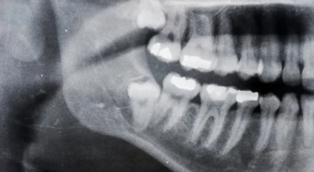 Una radiografía dental que muestra por qué la extracción de muelas del juicio es necesaria para aliviar el dolor de mandíbula.