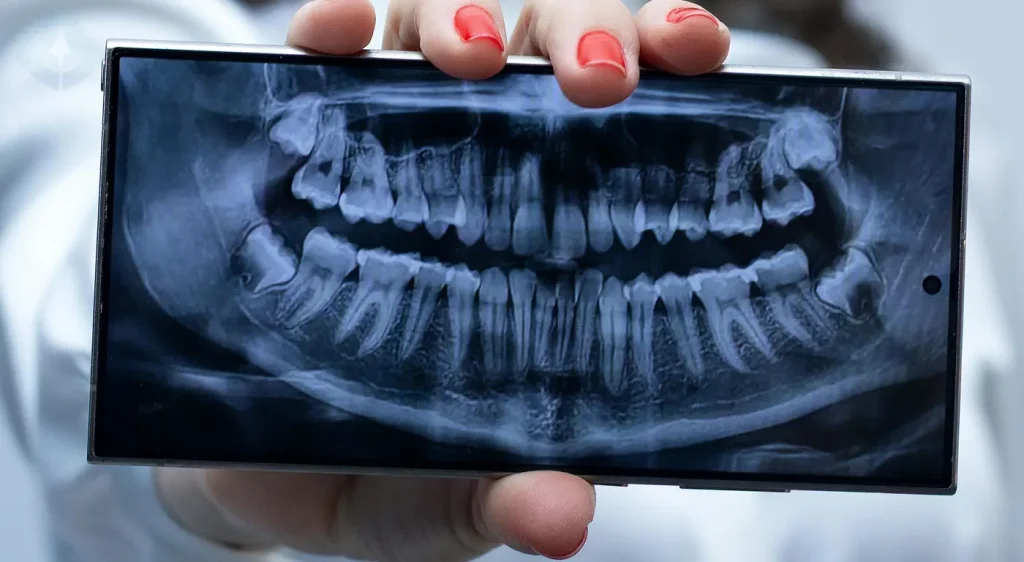 Radiografía digital mostrando muelas del juicio antes de Implantes Dentales en Westfield