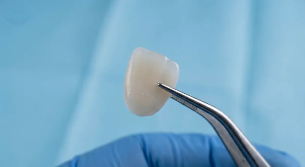 Primer plano de una carilla de porcelana de alta calidad para cerrar diastemas